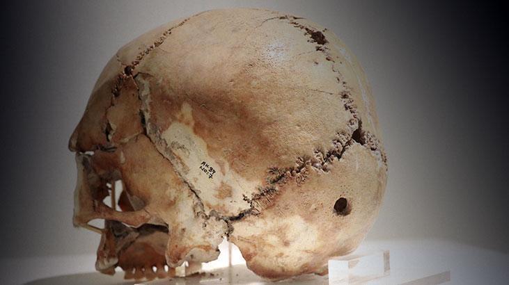 Yer: Aksaray! Dünyanın ilk beyin ameliyatında şaşırtan detay