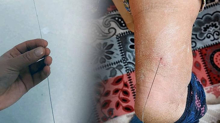 Ayak topuğunda bir anda tel çıkmaya başladı! Nereden geldiğini bulmaya çalışıyorlar