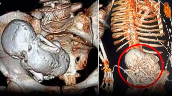 Karnından taşlaşmış bebek çıktı! Doktorlar tespiti yapar yapmaz öldü, akılalmaz olay