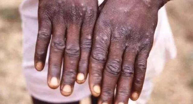 DSÖ’den Maymun Çiçeği Virüsü Uyarısı: “Uluslararası Halk Sağlığı Acil Durumu”