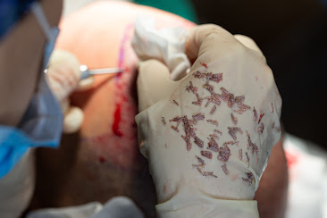 Uzman Doktorlarla Saç Ekimi: Clinista Saç Ekim Merkezi’nin Garantisi