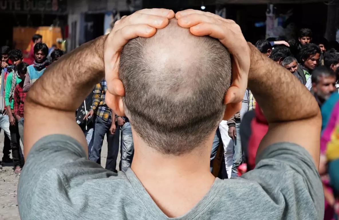 Hindistan’da Yeni Bir Virüs Panik Yarattı: 155 Kişi Ani Saç Dökülmesi Nedeniyle Kel Kaldı