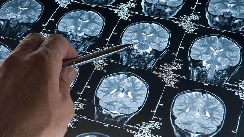 ALZHEİMER ARAŞTIRMASINDA DİKKAT ÇEKEN BULGU: UYKU BEYİN DALGALARI KORUYUCU OLABİLİR